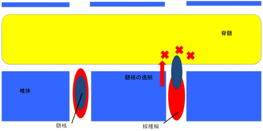 椎間板ヘルニア図解