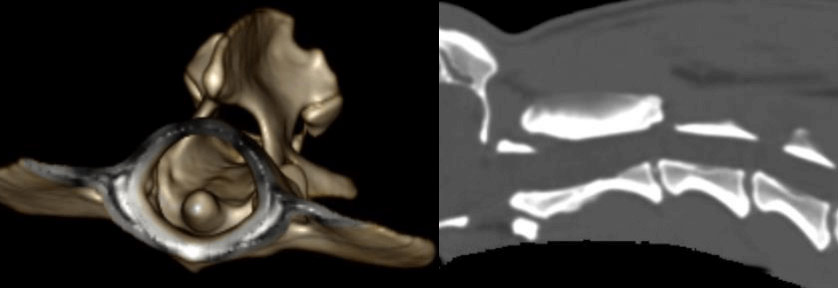 環椎軸椎不安定症非罹患犬のCT画像