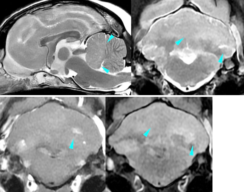 起源不明の髄膜脳脊髄炎のMRI検査 写真